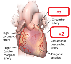 #1- left coronary artery
#2- left marginal artery