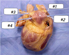 #1-right superior pulmonary vein
#2-right inferior pulmonary vein
#3-left superior pulmonary vein
#4-left inferior pulmonary vein