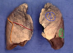 #1-superior lobe of left lung
#2-inferior lobe of left lung