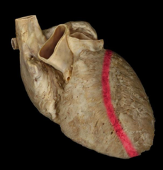 anterior inter ventricular septum