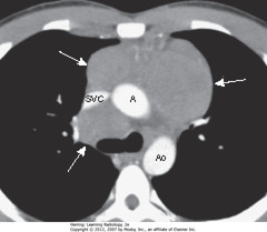 ANTERIOR MEDIASTINAL ADENOPATHY IN HODGKIN DISEASE
• SWA: lymphomas produce multiple, lobulated soft-tissue masses or a large soft-tissue mass from node aggregation
• Mass usually homogeneous in density, but may be heterogeneous when nodes large enough to undergo necrosis (areas of low attenuation, i.e., blacker) or hemorrhage (areas of high attenuation, i.e., whiter)
• SVC compressed by nodes, ascending (A) and descending aorta (Ao) typically less so