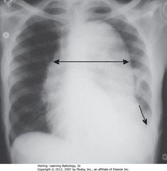 AORTIC DISSECTION
• DBA: widened mediastinum
• SBA: L pleural effusion
• Widened mediastinum + L pleural effusion in pt w/chest pain - signs of aortic dissection