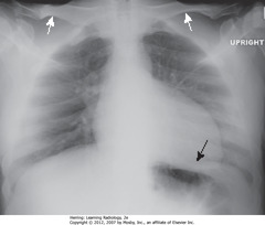 APICAL LORDOTIC CXR
• Most frequently inadvertent - patients semirecumbant
• WA: clavicles projected above first ribs, normal 