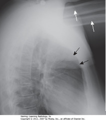 ARMS OBSCURING RETROSTERNAL SPACE
• WA: humeri visible
• BA: soft tissue of arms - not anterior mediastinal adenopathy
