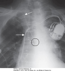 ARTERIAL PLACEMENT OF CVL
• DWA: medial end of clavicle - catheter doesn't reach here before descending (it should)
• Black circle: catheter tip, oriented over spine, away from SVC
• SWA: SVC
• Suspect arterial placement if flow is pulsatile