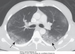 ASPIRATION, LLs
• SBA: LL airspace dz in pt that aspirated
• Affects most dependent parts of lung - LLs if upright, superior LLs and posterior ULs most involved
• Usually clears w/in 24-48 hours