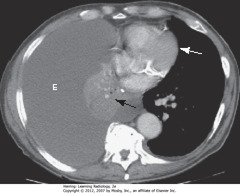 ATELECTASIS AND EFFUSION
• E: large PLEURAL EFFUSION
• BA: atelectasis of right lung
• Balance between atelectasis and effusion = no shift of midline structures
• WA: heart in normal position
• Strongly suggestive of central bronchogenic malignancy w/malignant effusion