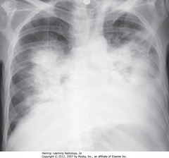 BAT-WING OF PULMONARY EDEMA
•CXR findings of pulmonary alveolar edema: fluffy, indistinct, patchy airspace densities, often centrally located and not affecting outer third of lung
• Suggests pulmonary edema vs other airspace diseases such as PNA
• Patterns of cardiogenic and noncardiogenic pulmonary edema overlap
• Absence of pleural effusions, absence of fluid in fissures, and normal-sized heart indicate noncardiogenic cause
• Dx: septic shock from an overwhelming urinary tract infection