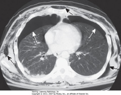 BILATERAL PTXs
• Smaller PTX may only be visible on chest CT
• SWA: bilateral pneumothoraces
• Air rises to highest point (pt supin in CT)
• SBA: extensive subcutaneous emphysema, developed from air leak from chest tube inserted earlier
