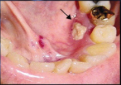 Bisphosphonate-associated Osteonecrosis of the Jaw
