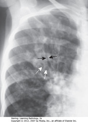 BRONCHIECTASIS CF
• SBA: Tram Tracks - parallel line opacities on CXR due to thickened walls of dilated bronchi
• SWA: cystic bronchiectasis - cystic lesions as large as 2 cm in diameter 
• Bilateral upper lobe bronchiectasis in children highly suggestive of cystic fibrosis
