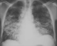 Bronchopneumonia CXR