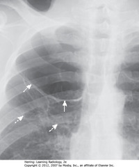 BULLOUS DISEASE, RUL 
• SWA: white line in RUL, no lung markings peripheral to it
• Line is convex away from chest wall, doesn't parallel chest wall curve
• Classic appearance of bulla of emphysema
• Placing CT into bulla almost always causes PTX that can be hard to re-expand
• DWA: walls of several bullae
• Vanishing lung syndrome: bullae so large that Ht seems devoid of visible lung tissue