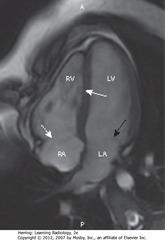 CARDIAC MRI, HORIZONTAL LONG AXIS/FOUR-CHAMBER VIEW 
• SWA: interventricular septum separating RV and LV
• Posterior to each - RA and LA
• DWA: tricuspid valve
• SBA: mitral valve
• A = anterior, P = posterior