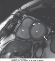 CARDIAC MRI, SHORT AXIS VIEW
• SWA: Interventricular septum, separating RV and LV
• DWA: wall of LV
• A = anterior, P = posterior