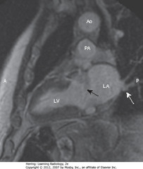 CARDIAC MRI, VERTICAL LONG AXIS/CHAMBER VIEW
• SBA: MV area separating LA from LV
• SWA: pulmonary veins, drain into LA
• Ao = aorta, PA = pulmonary artery, A = anterior, P = posterior
