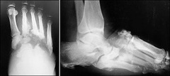 Charcot Arthropathy (Neuropathic Joint destruction, usually insidious onset in Diabetics)