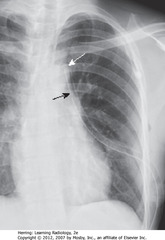 CHEST TUBE - CORRECT POSITION
• DBA: side hole of chest tube - stripe breaks at site of side hole
• SWA: ideal position - anterosuperior for evacuating PTX and 
• Ideal position for draining effusion = posterior (work regardless of where positioned)