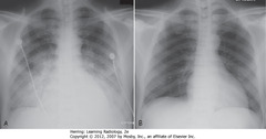 CLEARING PULMONARY EDEMA
• Onset and clearance of pulmonary edema area fast
• A: Bilateral, perihilar airspace disease, diffuse prominence of interstitial markings characteristic of pulmonary edema
• B: After 4 days, lungs clear
• ARDS, other coexisting diseases - don't clear as fast