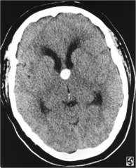 Colloid Cyst (with early hydrocephalus)