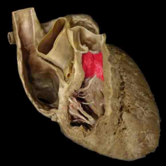 conus arteriosus of right ventricle