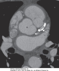 CORONARY ARTERY CALCIFICATION
•SWA: dense calcification in L anterior descending coronary artery arising from aorta (A)