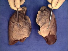 costal surface of the lung