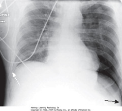 DEEP SULCUS SIGN
• SBA: When supine, air in large PTX collects anteriorly/inferiorly in thorax, manifests by displacing costophrenic sulcus inferiorly, while producing increased lucency of that sulcus (deep sulcus sign)
• Sign of PTX on supine CXR
• SWA: right sulcus - not as low as L costophrenic sulcus