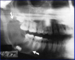 Dentigerous Cyst vs Ameloblastoma