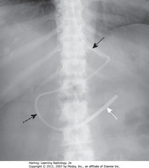 DOBBHOFF IN DUODENUM
• Tip should be in duodenum 
• SWA: weighted, metallic end
• SBA: Dobhoff enters stomach
• DBA: duodenal sweep
• SBA: junction of L Hd and L side of thoracic spine (L cardiophrenic angle) - usual place