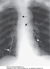 DOBBHOFF IN L & RLL BRONCHI
• DBA: Dobhoff enters trachea
• DWA: Dobhoff in LLL bronchi
• SBA: coiled back on itself to cross midline
• SWA: Dobhoff in RLL