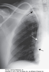 DOUBLE-LUMEN CATHETER, CORRECT POSITION
• DBA: central stripe of large-bore catheter
• SWA: tip for blood withdrawal further from heart than tip for blood return
• SBA: tip for blood return
• R IJ most often used for access
• This cath has two, separate, single-lumen caths, one tip in SVC and other in RA