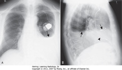 DRESSLER SYNDROME (POSTPERICARDITIS/POST-MI SYNDROME)
• SBAs: L pleural effusion
• 2-3w after transmural MI or pericardiotomy (CABG)
• CP + fever + L pleural effusion + patchy LLL airspace disease + pericardial effusion several weeks post-MI or CABG
• DBAs: pacer leads in RA
• Arrowhead: pacer leads in RV