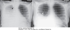 EFFECT OF PATIENT POSITIONING
• A - SBA: Recumbent - R-sided effusion layers along posterior pleural surface, produces 