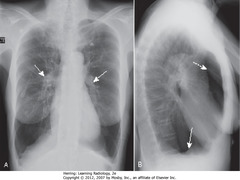 EMPHYSEMA
• Prominent pulmonary arteries 2° pulmonary arterial HTN (A - SWA)
• Flattened diaphragm (B - SWA)
• Increased retrosternal clear space (B-DWA)
• Hyperlucency of lungs with less than normal normal vascular markings
• CXR findings of COPD: hyperinflation, flattening of diaphragm, especially on lateral exposure