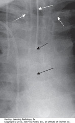 ETT IN SATISFACTORY POSITION
• SWA: radioopaque marker stripe of ETT (usually wide-bore - 1 cm), no side holes
• DBA: diagonal tip of ETT
• SBA: carina - with head in neutral position, ETT tib should be 3-5 cm away (half distance between medial ends of clavicles and carina
• DWAs: medial ends of clavicles