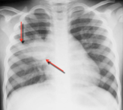 Findings in primary TB