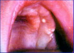 Gingival (alveolar) Cyst of the newborn