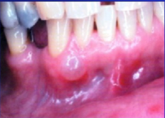 Gingival Cyst of the adult