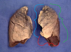 green line = posterior border of the left lung
red line = inferior border of the left lung
blue line = anterior border of the left lung