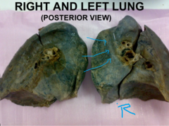 impression for SVC on right lung 
key: look for apex of the lung, identify impressions from there