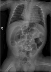 Inguinal Hernia with Obstruction