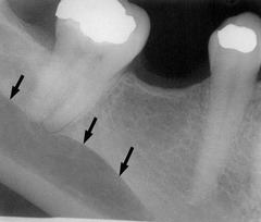 internal oblique ridge and submandibular fossa