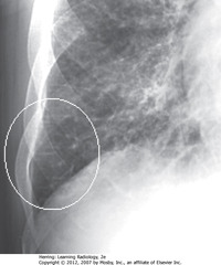 KERLEY B LINES
• White oval: Kerley B lines - 1-2 cm long, 1 mm thick, horizontal lines perpendicular to, abutting pleural surface
• Interlobular septae not visible on normal CXR but become visible with fluid accumulation