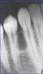 Lateral Periodontal Cyst