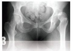 Left Posterior Hip Dislocation