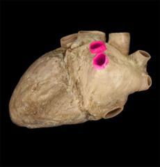 left pulmonary veins 
(indicate superior/inferior)