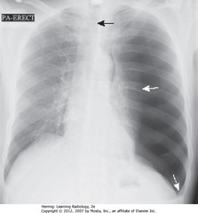 LG LEFT-SIDED TENSION PTX
• SWA: L lung almost totally compressed
• SBA: trachea; trachea and heart shifted to right
• DWA: L Hd depressed due to increased L intrathoracic pressure