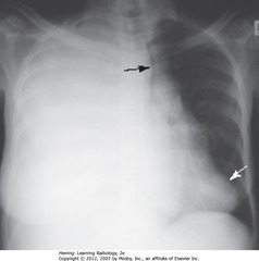 LG PLEURAL EFFUSION - MASS EFFECT
• Black arrow: trachea to L, apex of heart to L 
• White arrow: apex of heart - displaced to L, close to lateral chest wall
• Thoracentesis removed 2L serosanguinous fluid