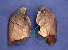 lingula of lung